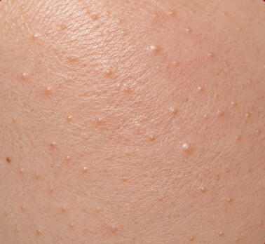 Tiny Bumps