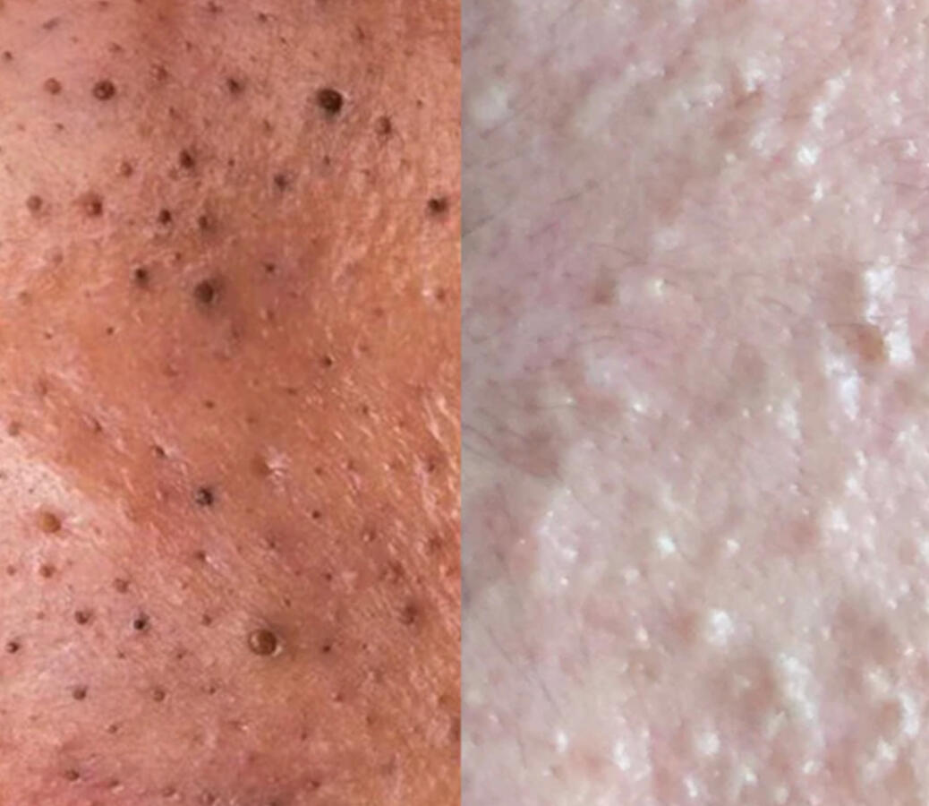 Blackheads / Whiteheads
