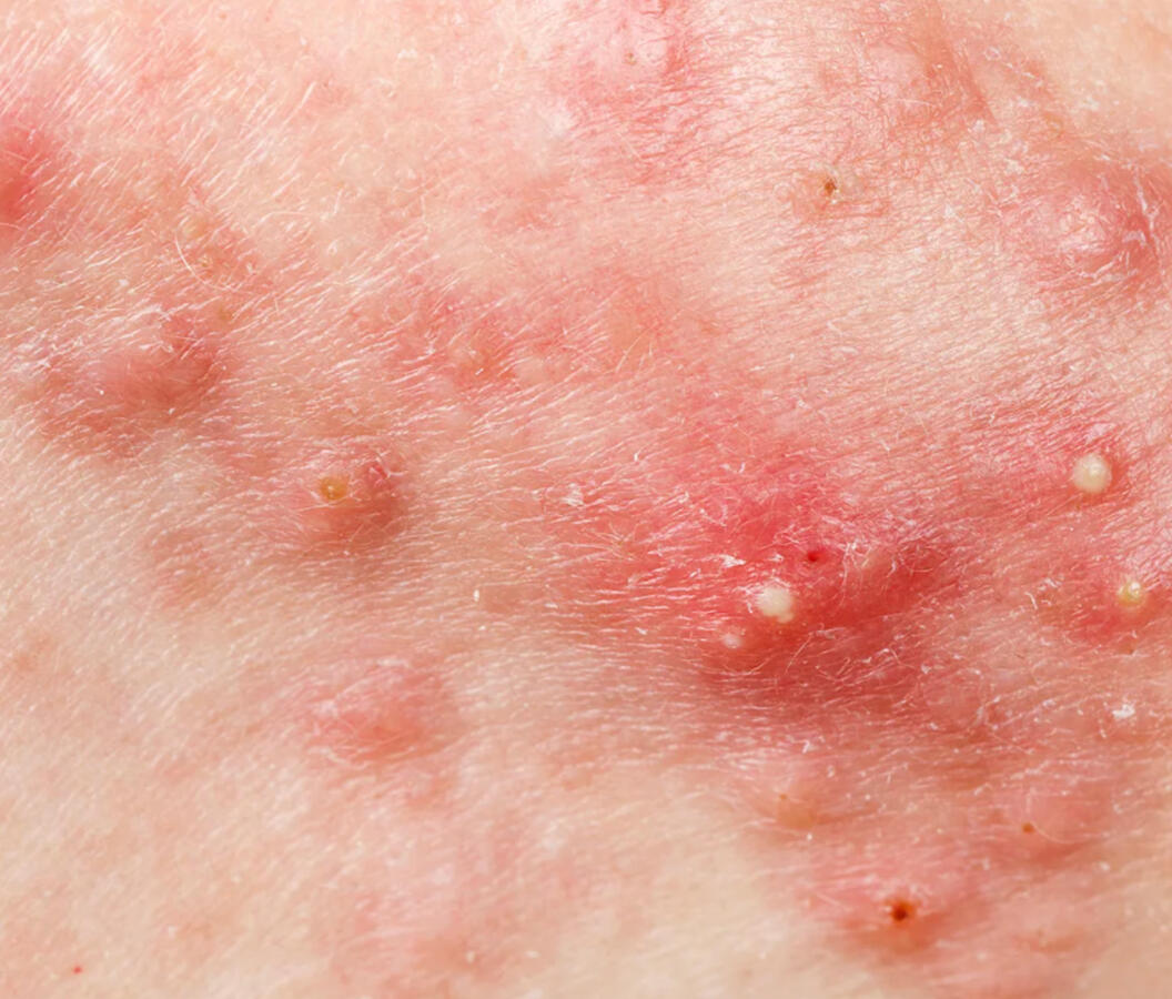 Hormonal Acne (Acne Vulgaris)