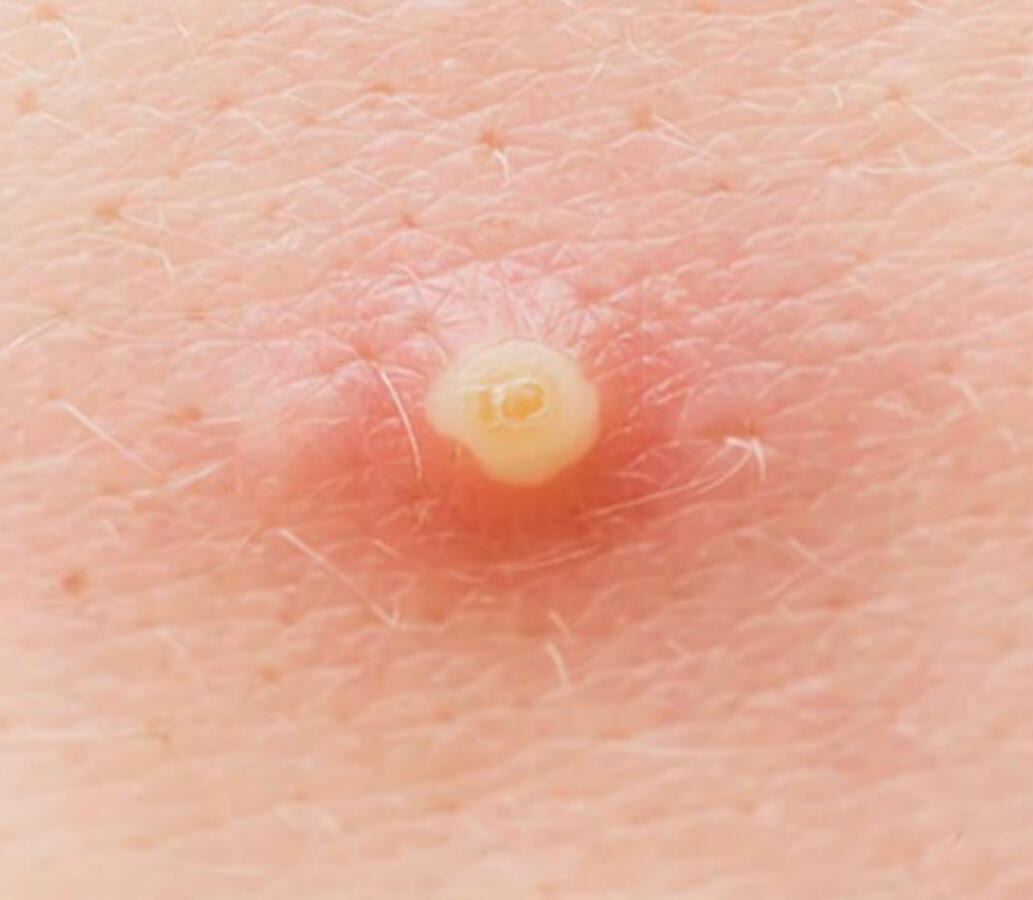 Standard Pimple (Pustule)